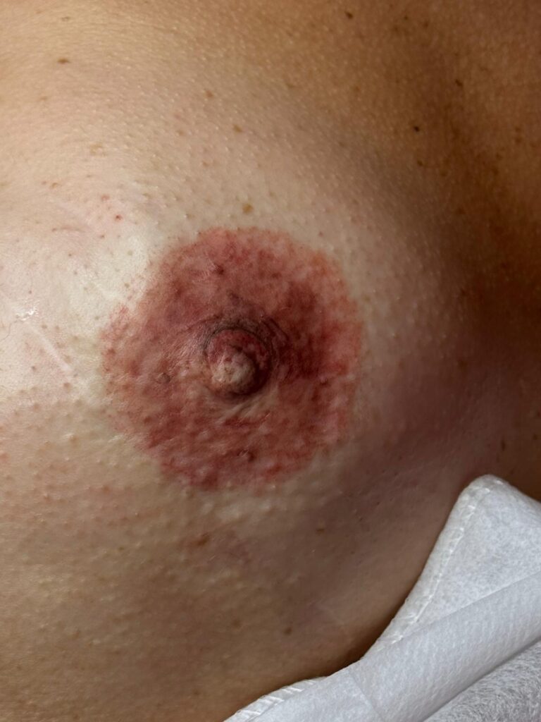 ENZA TRUCCO PERMANENTE
dermopigmentazione dell'areola mammaria
trattamento ed indicazioni post